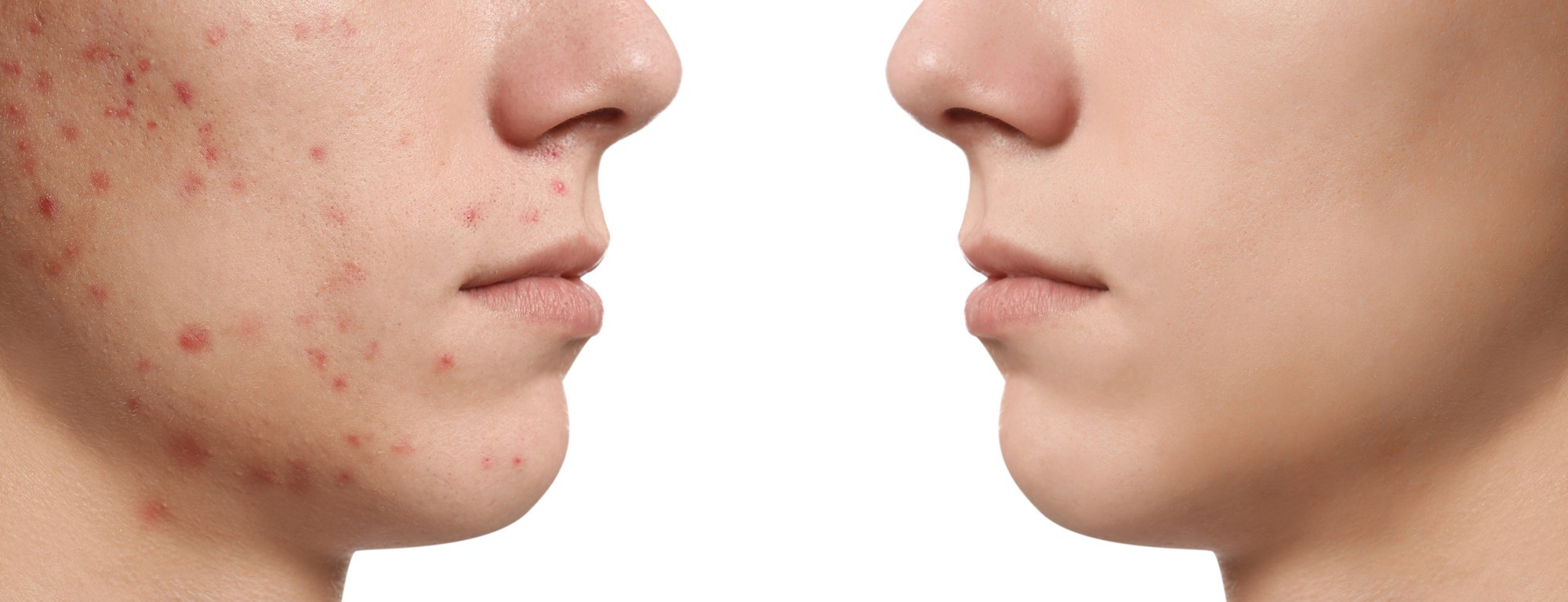 Teenager before and after Acne Treatment on White Background, Closeup